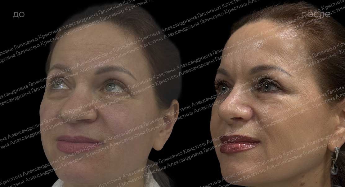 Нижняя блефаропластика с миопексией