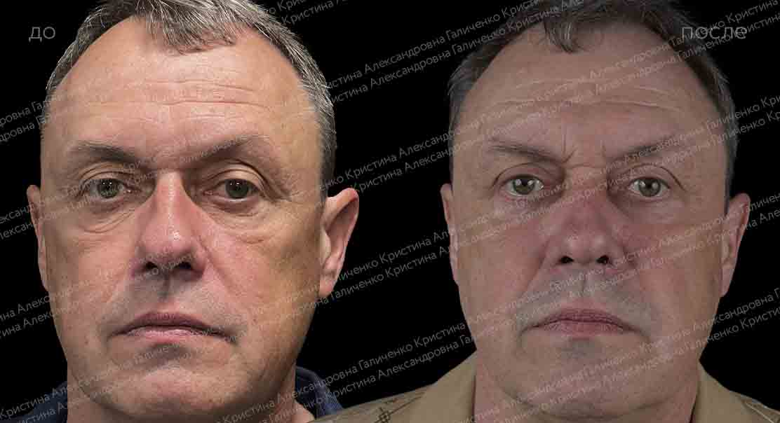 Пластика верхних и нижних век