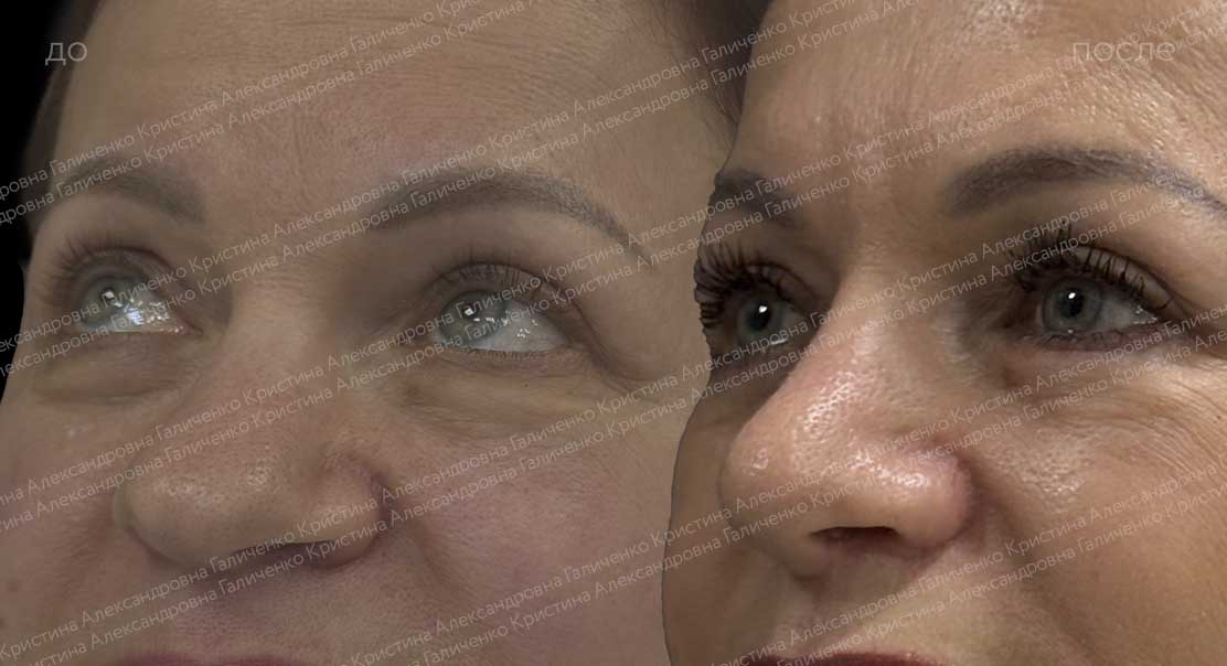 Нижняя блефаропластика с миопексией