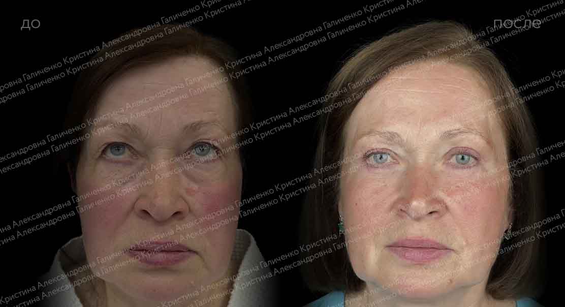 Круговая блефаропластика с миопексией