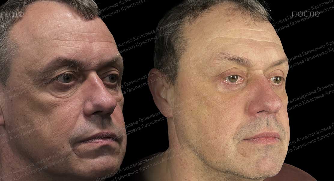 Пластика верхних и нижних век