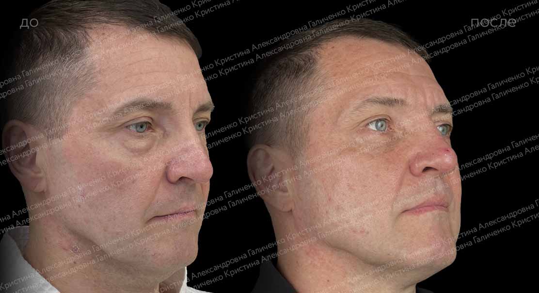 Нижняя блефаропластика