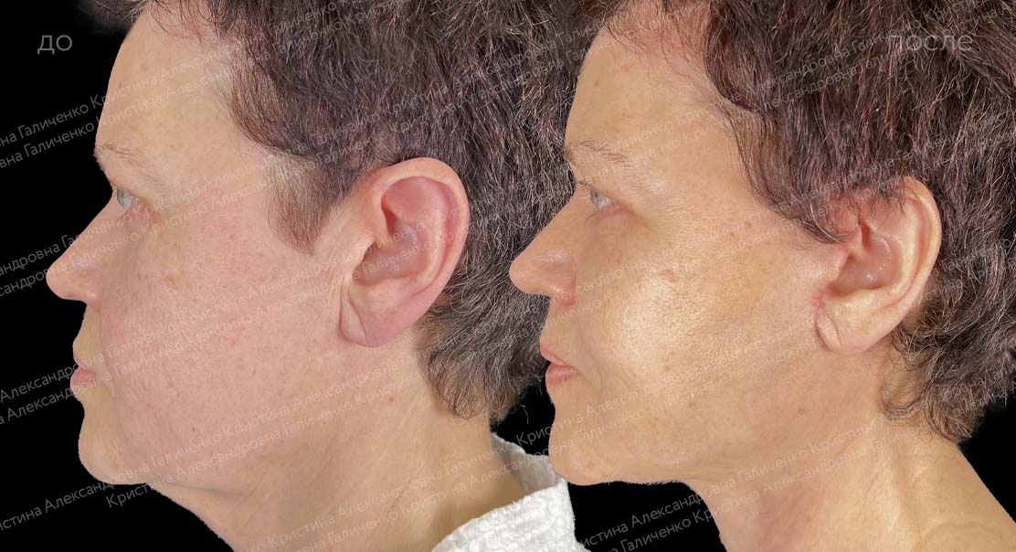 Круговая подтяжка лица и шеи