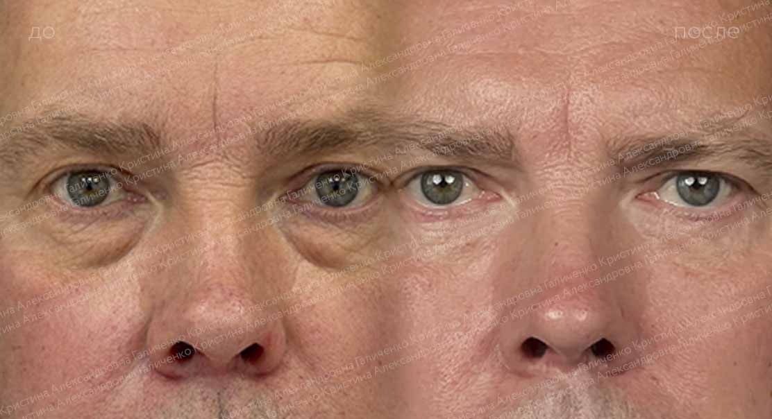 Нижняя блефаропластика + миопексия