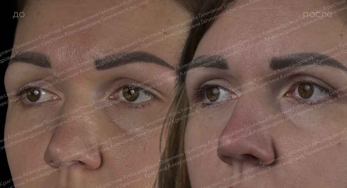 Верхняя блефаропластика