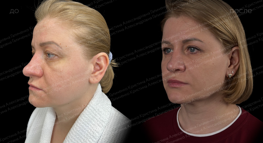 Круговая блефаропластика