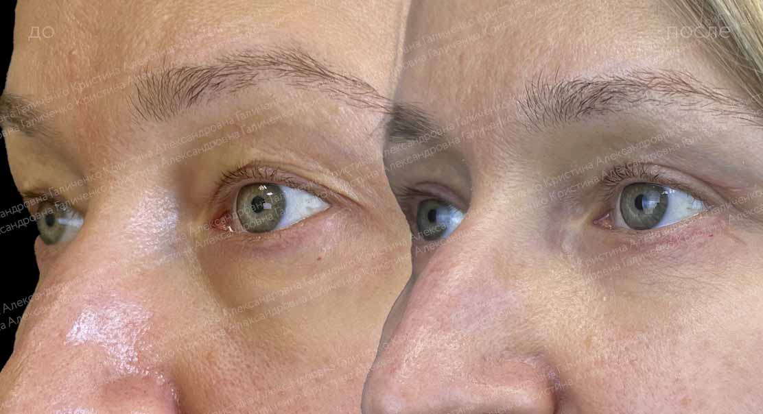 Круговая блефаропластика