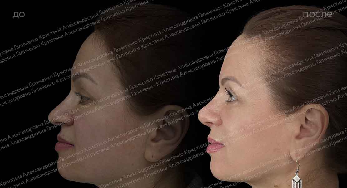 Нижняя блефаропластика и миопексия