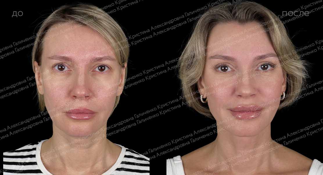Платизмопластика + эндоскопический лобно-височный лифтинг