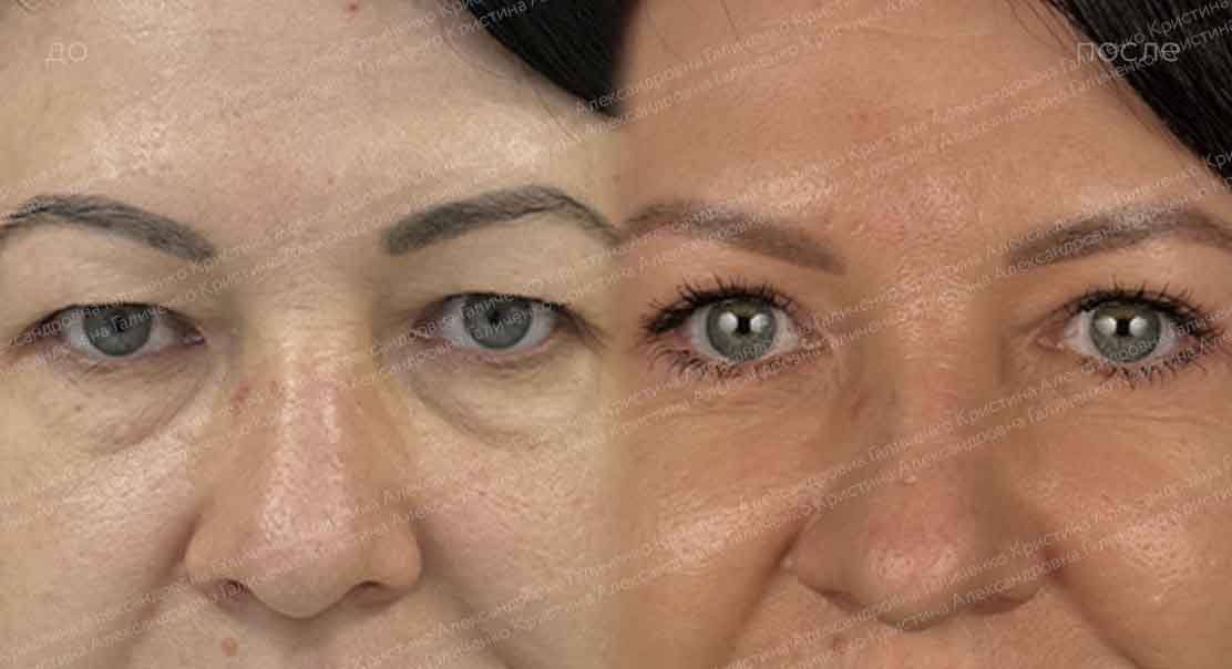 Круговая блефаропластика и миопексия