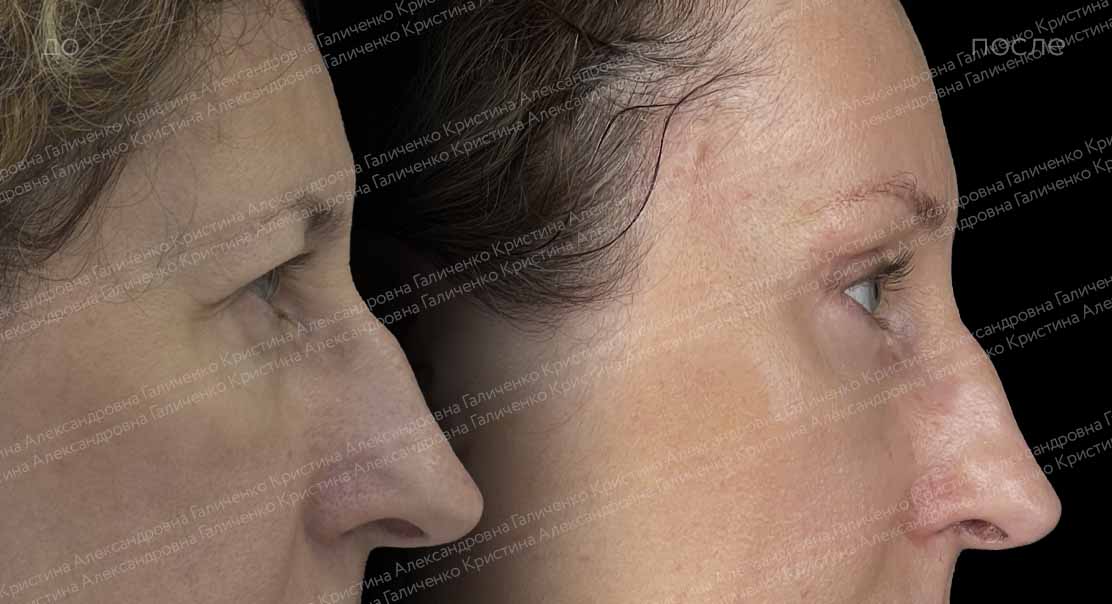Верхняя блефаропластика + эндоскопический лобно-височный лифтинг