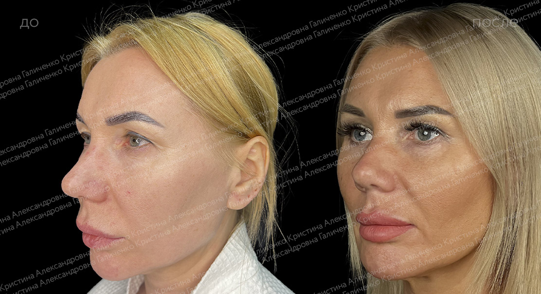 Эндоскопический лобно-височный лифтинг + верхняя блефаропластика