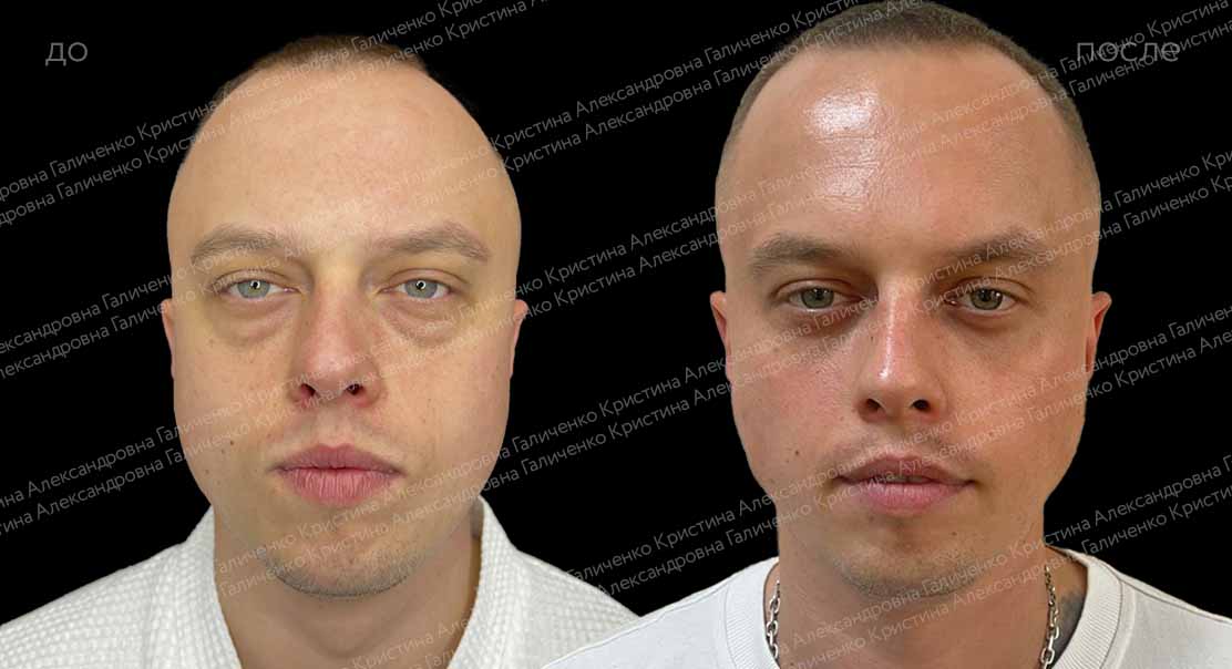 Нижняя трансконъюнктивальная блефаропластика