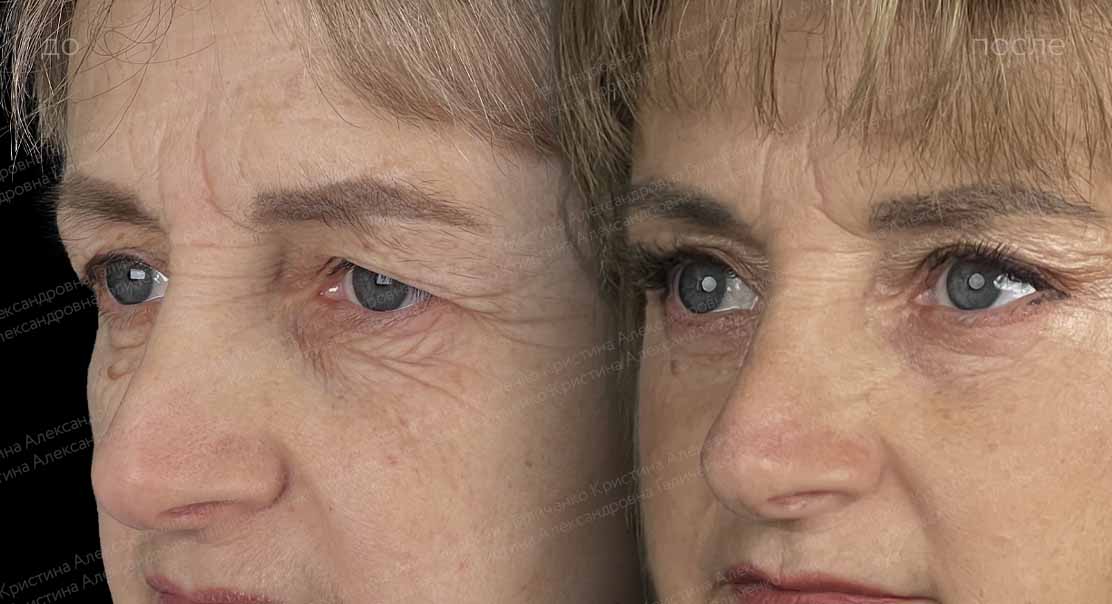 Эндоскопический лобно-височный лифтинг + круговая блефаропластика
