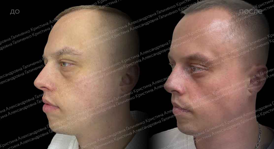 Нижняя трансконъюнктивальная блефаропластика