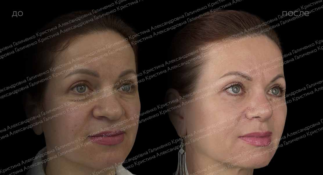 Нижняя блефаропластика и миопексия