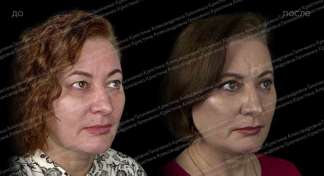 Верхняя блефаропластика