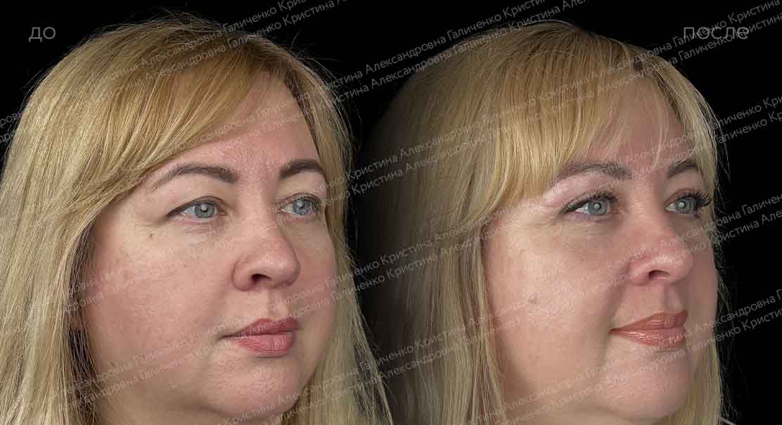 Верхняя блефаропластика