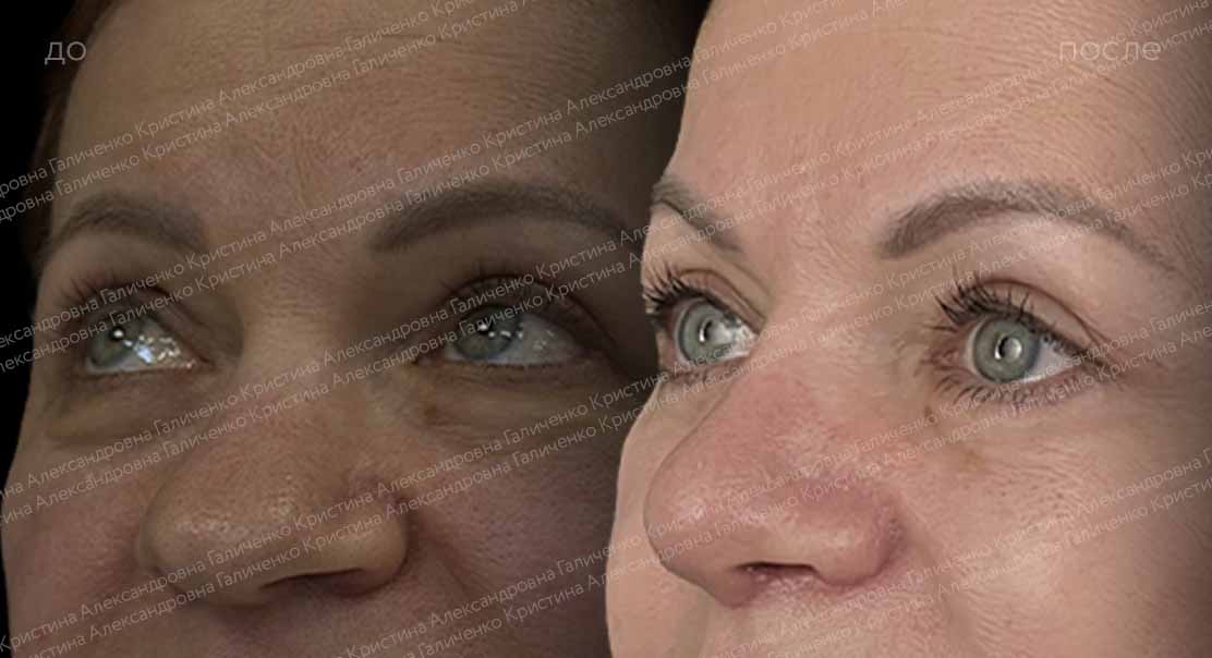 Нижняя блефаропластика и миопексия