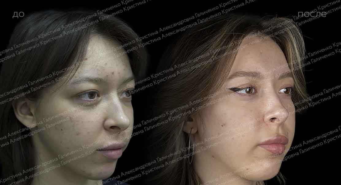 Круговая блефаропластика