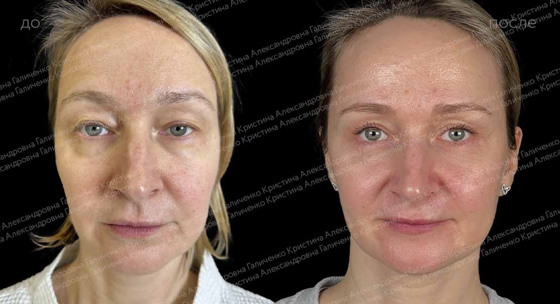 Круговая блефаропластика