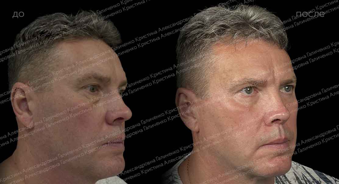 Нижняя блефаропластика + миопексия