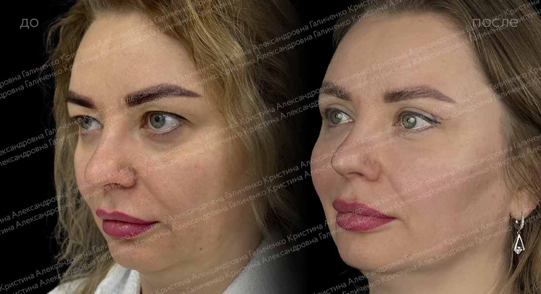 Ориентальная блефаропластика