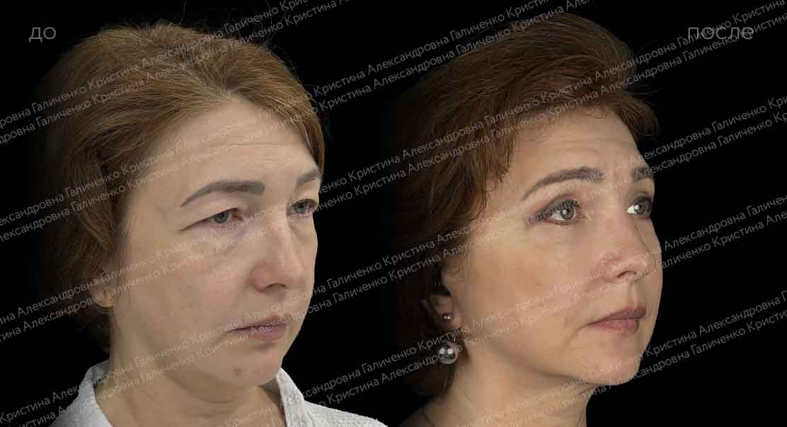Круговая блефаропластика с миопексией