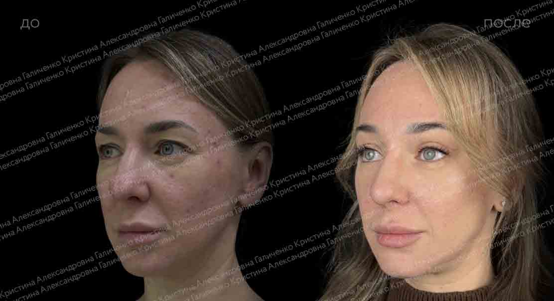 Эндоскопический лобно-височный лифтинг + верхняя блефаропластика