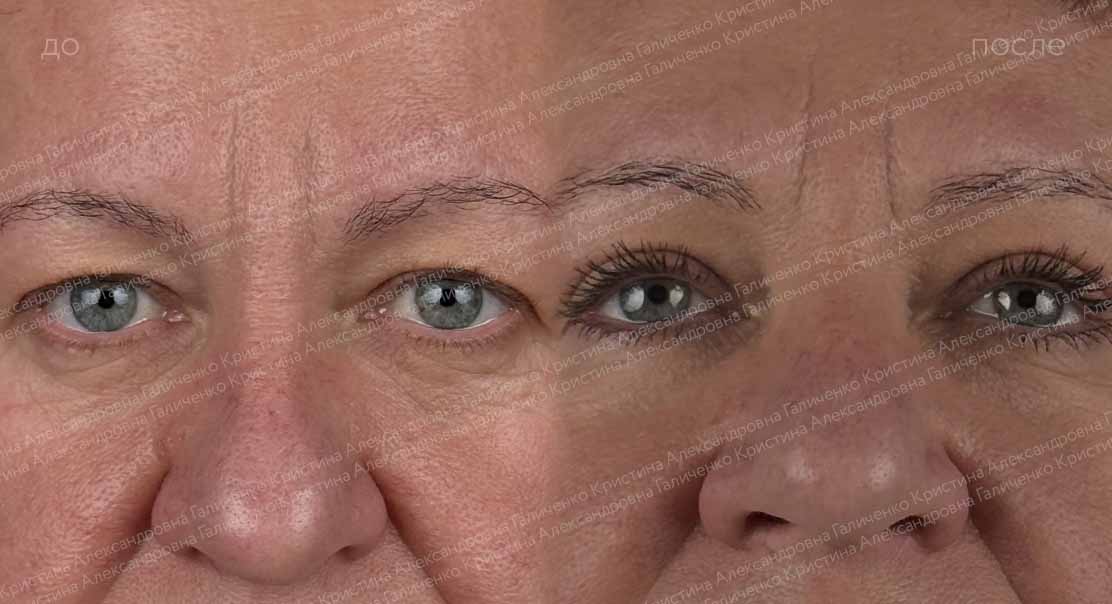 Верхняя блефаропластика
