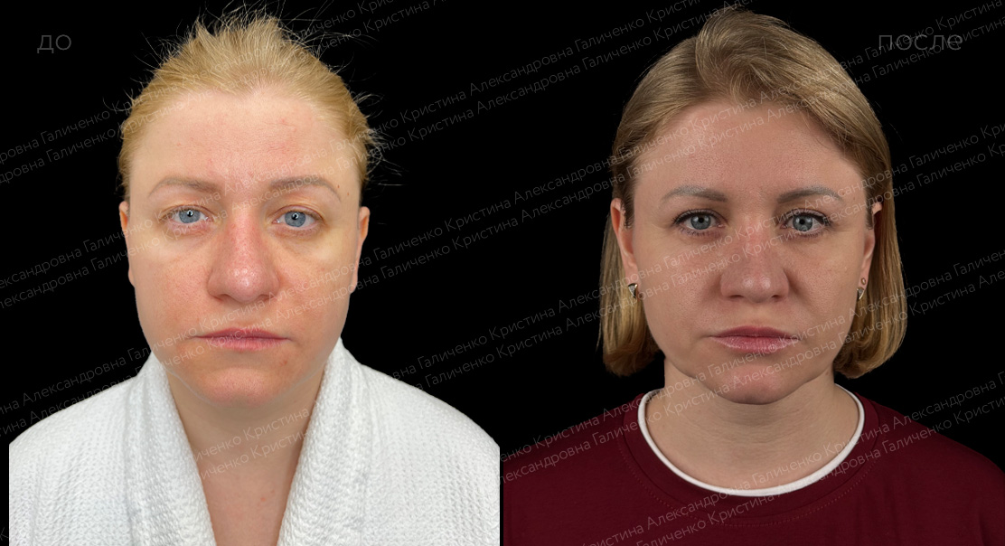 Круговая блефаропластика