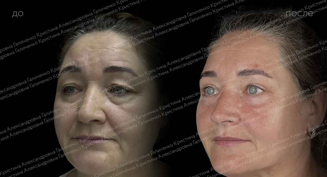 Пластика верхних и нижних век + миопексия