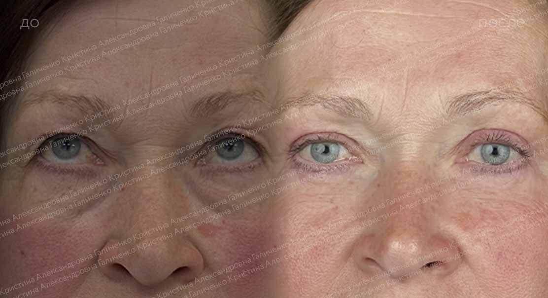 Круговая блефаропластика с миопексией
