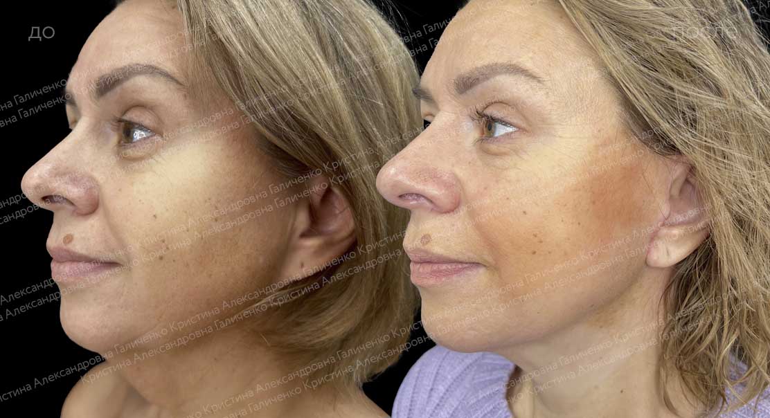 Подтяжка лица и шеи + липосакция подбородка
