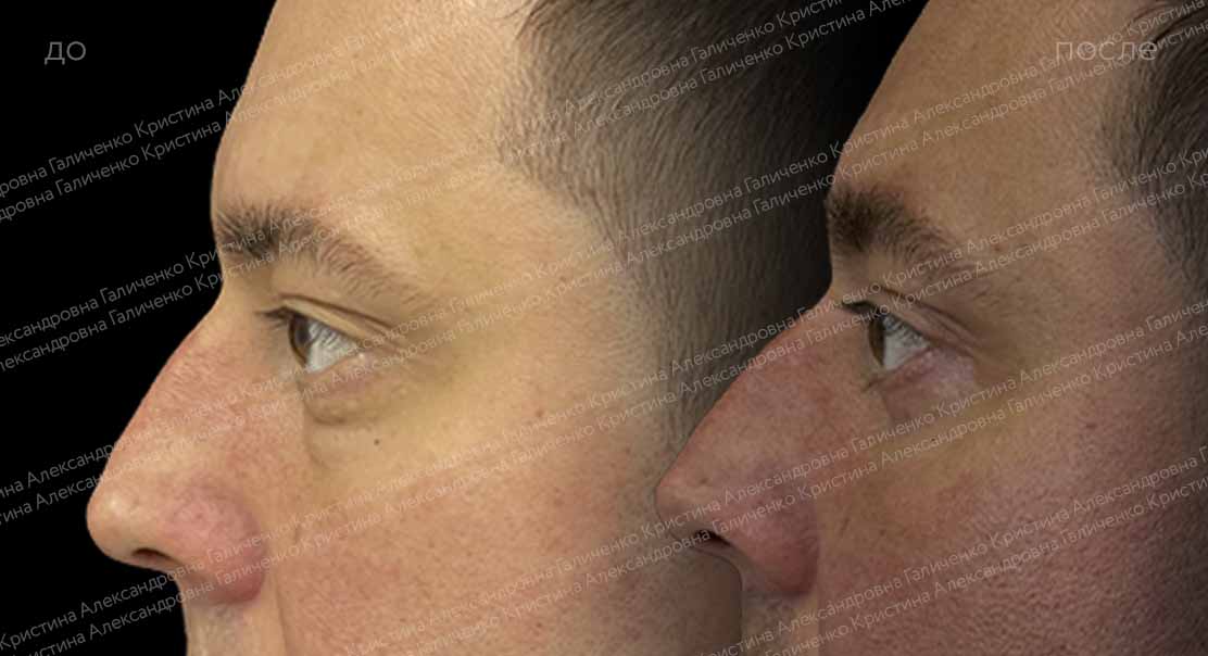 Нижняя блефаропластика и пластика нижней трети лица