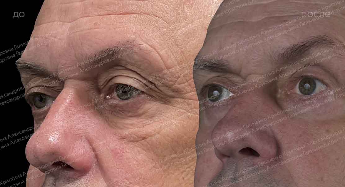Пластика верхних и нижних век