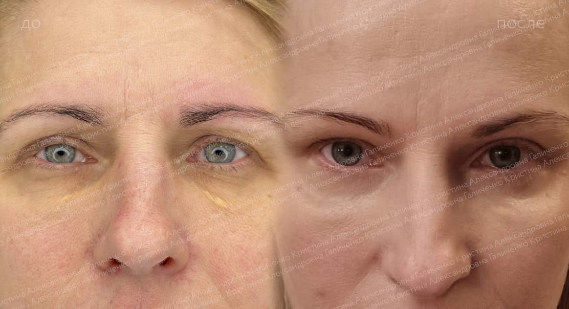 Нижняя блефаропластика + эндоскопический лобно-височный лифтинг