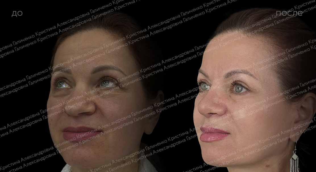 Нижняя блефаропластика и миопексия