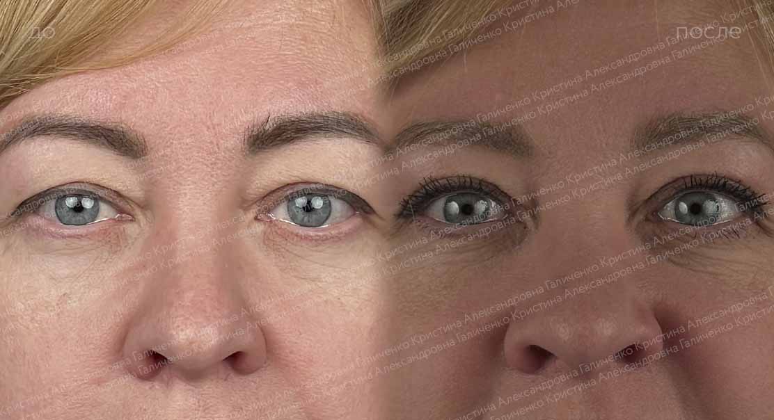 Верхняя блефаропластика