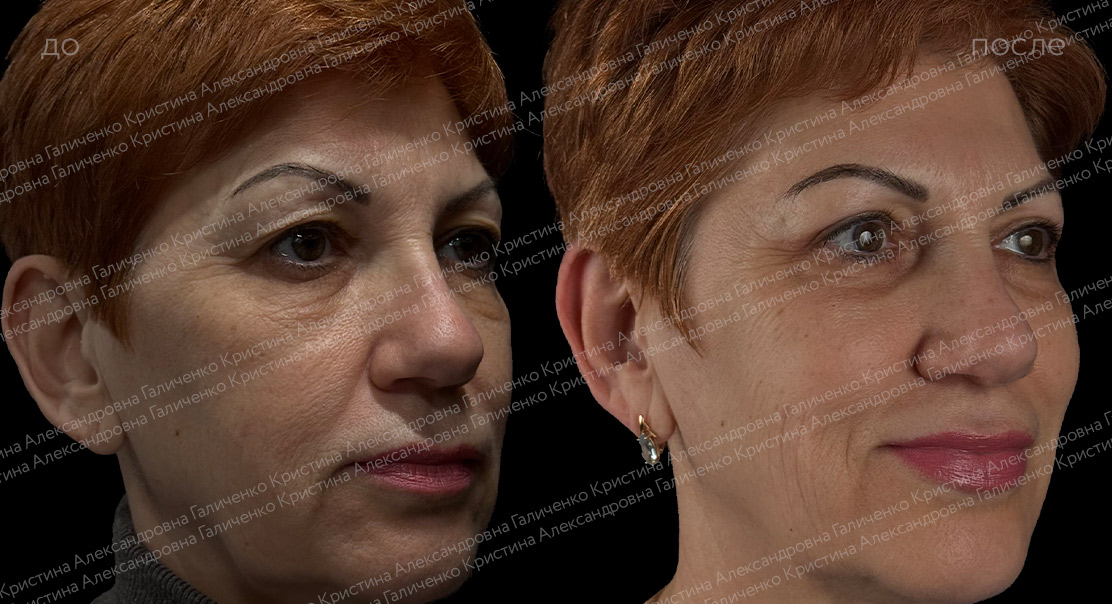 Круговая блефаропластика