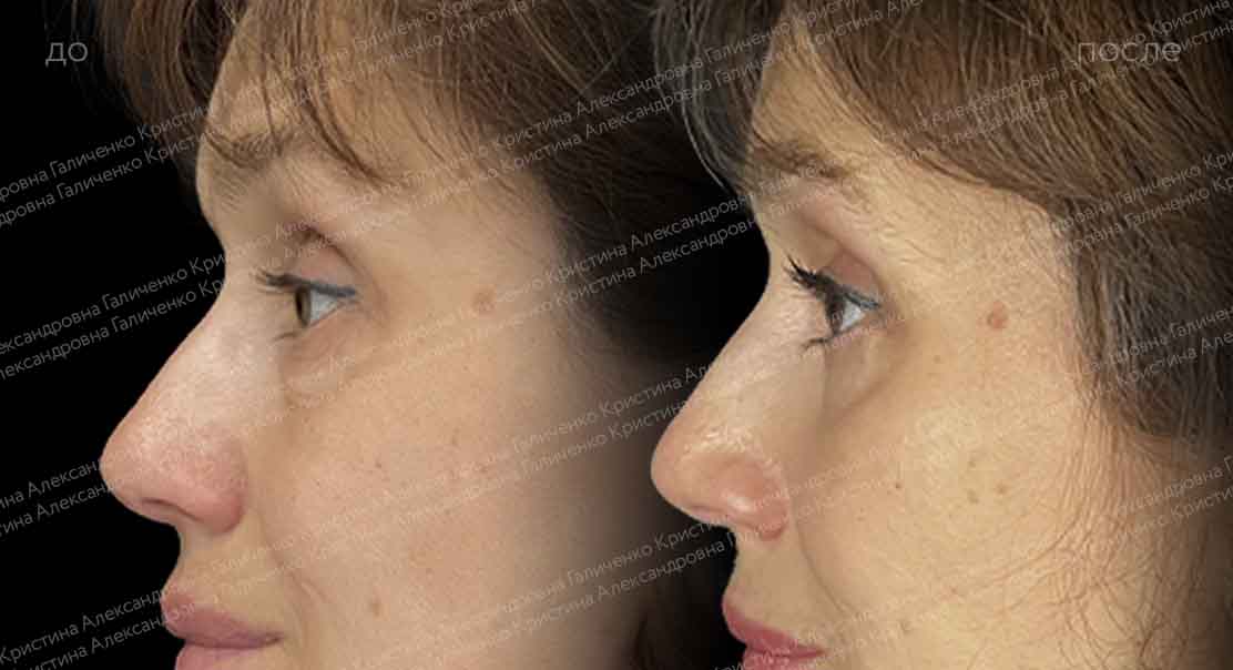 Нижняя блефаропластика и миопексия