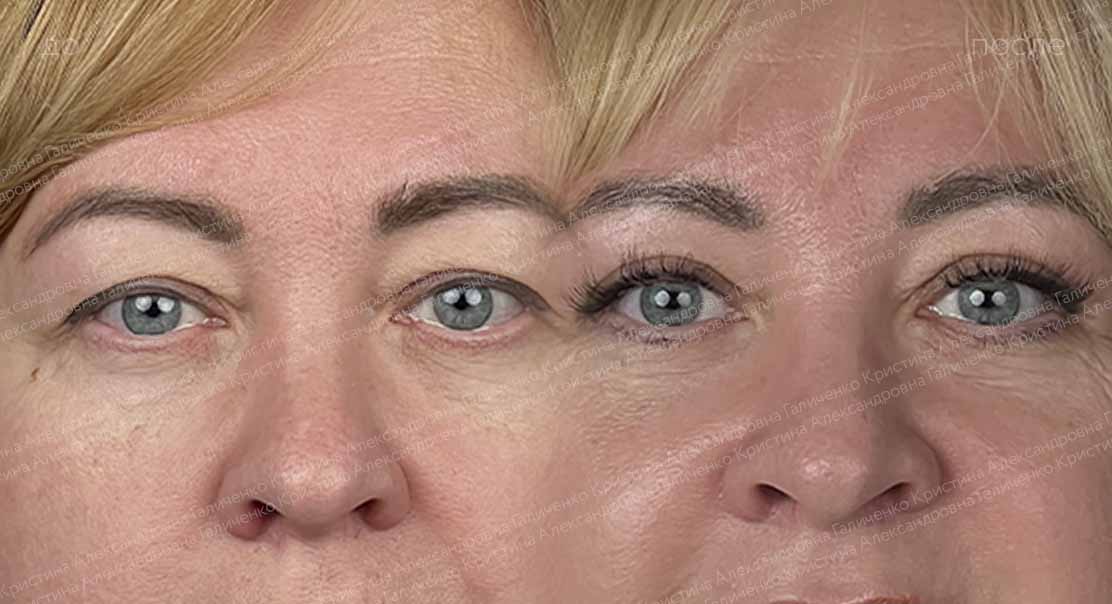 Верхняя блефаропластика