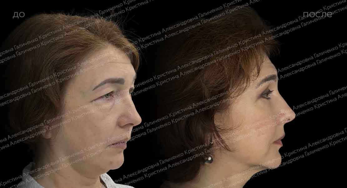 Круговая блефаропластика с миопексией