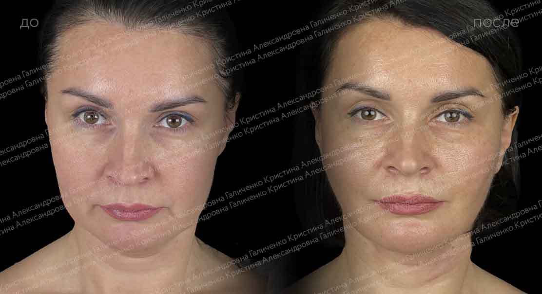 Комплексное омоложение лица и шеи