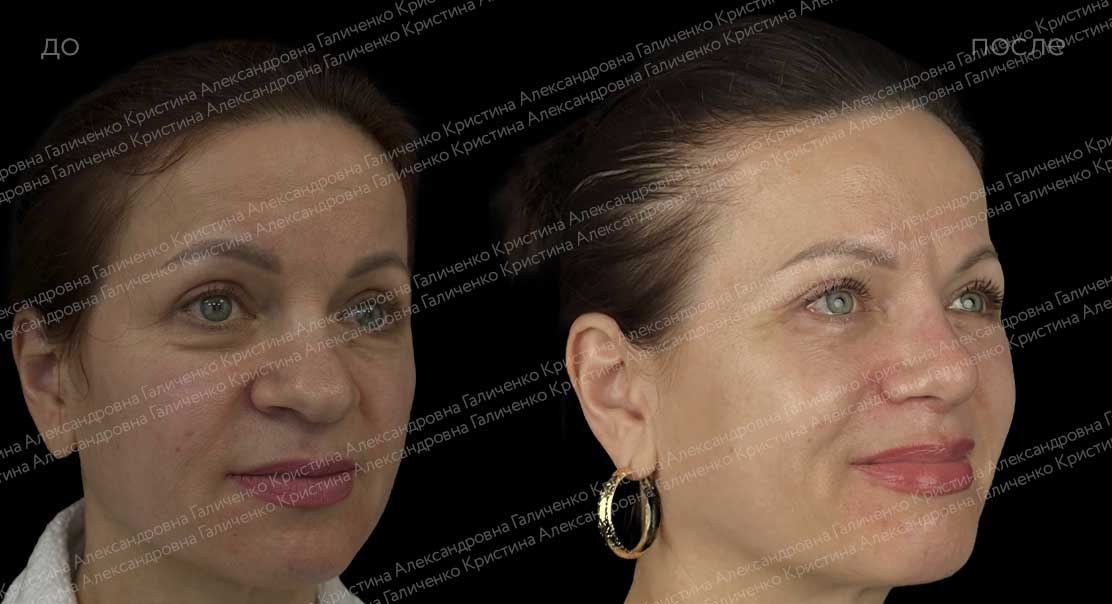 Нижняя блефаропластика с миопексией