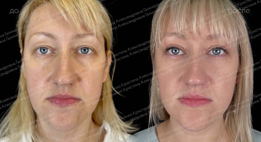 Классическая верхняя + трансконъюнктивальная нижняя блефаропластика