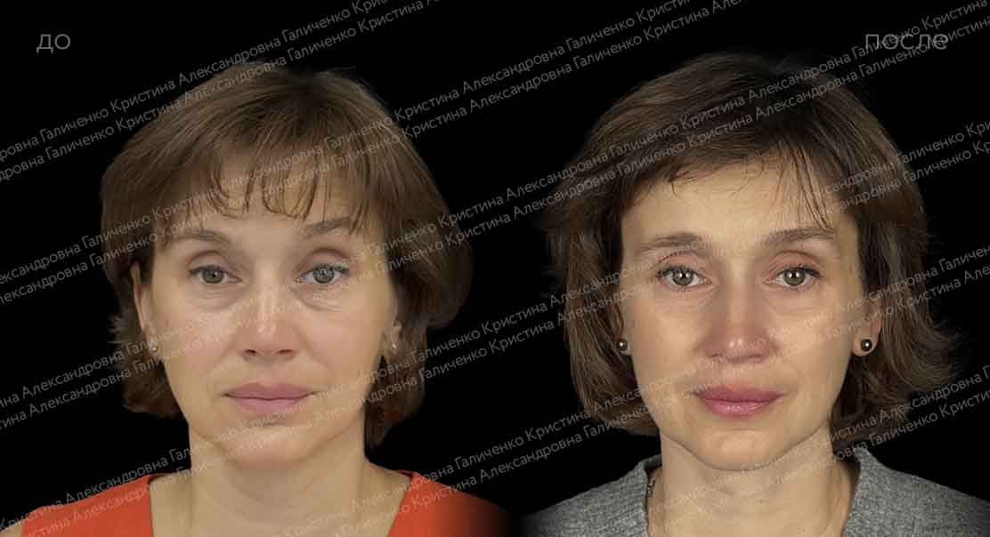 Нижняя блефаропластика и миопексия