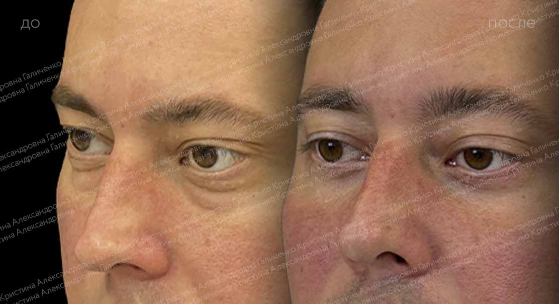 Нижняя блефаропластика и пластика нижней трети лица