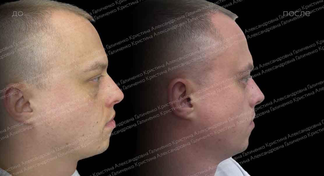 Нижняя трансконъюнктивальная блефаропластика