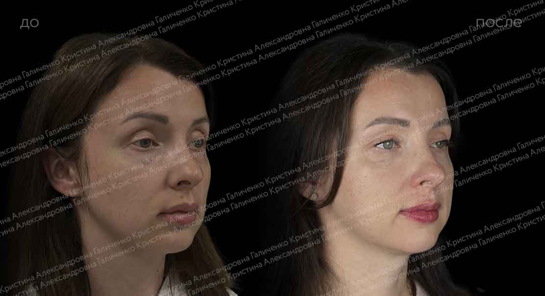 Пластика нижних век с миопексией